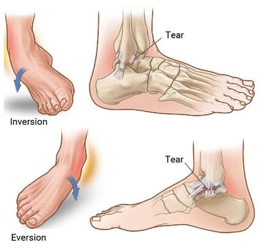 Preventing and Managing Ankle Sprains