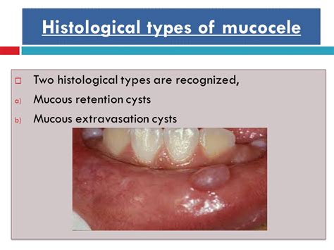 Granulation Tissue に対する画像結果