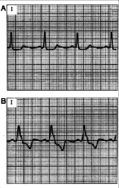 Image result for LBB ECG