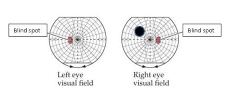 Image result for Visual Field Defect Disease