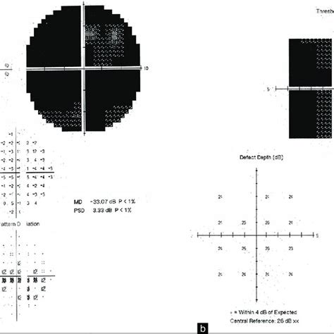 Image result for Macular Split Visual Field Glaucoma