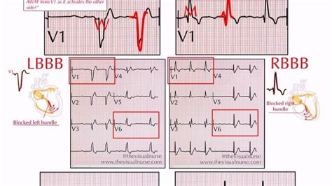 Toradh íomhá ar Left Bundle Branch Block and AFib
