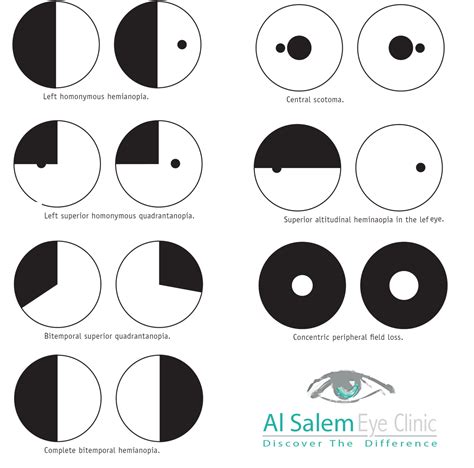Image result for Visual Field Defect Map