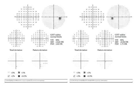 Unreliable Visual Field に対する画像結果