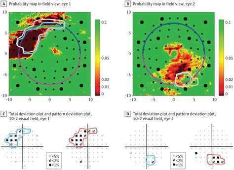 Image result for Macular Split Visual Field Glaucoma