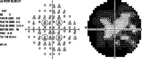 Afbeeldingsresultaten voor Visual Field Types