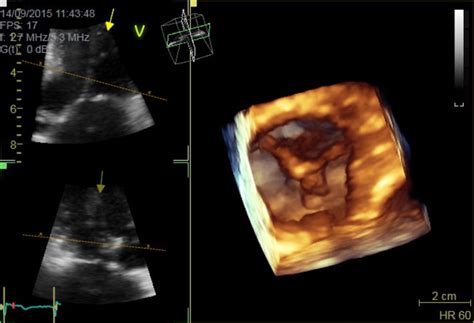 Image result for Intracavitaire Gradient