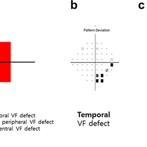 Image result for Visual Field Defect Disease