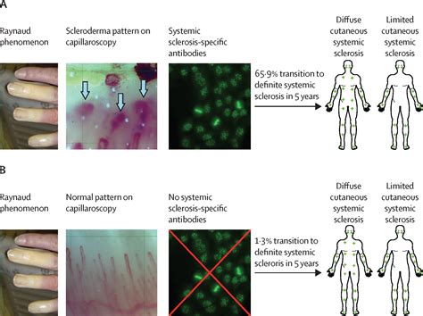 Diffuse Systemic Scleroderma に対する画像結果