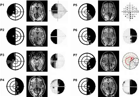 Image result for Deficit in One Visual Field