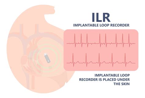 Loop Recorder Removal Procedure に対する画像結果