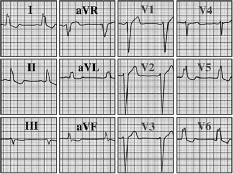 Image result for LBB ECG