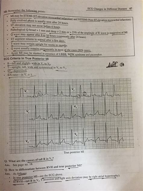Image result for LBB ECG