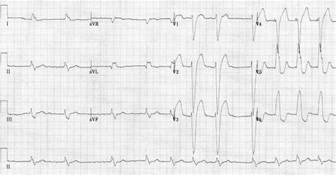 Image result for LBB ECG