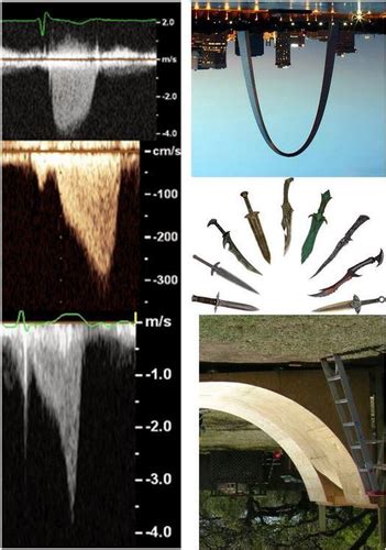 Image result for Intracavitaire Gradient