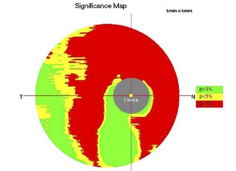 Tunnel Vision Visual Field Glaucoma に対する画像結果
