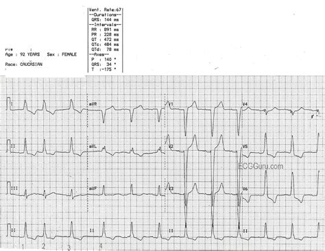 Cardiac MRI Left Bundle Branch Block に対する画像結果