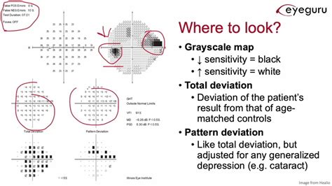 Image result for VFI Visual Field