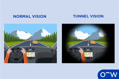 Tunnel Vision Visual Field Glaucoma に対する画像結果