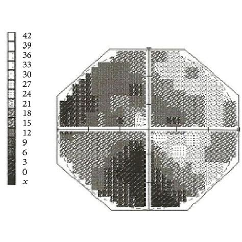 Image result for Sectoranopic Visual Field Defects