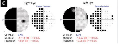 Image result for Stroke Visual Field Defects