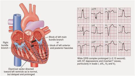 Cardiac MRI Left Bundle Branch Block に対する画像結果