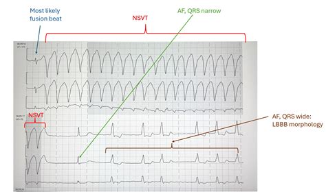 Toradh íomhá ar Left Bundle Branch Block and AFib