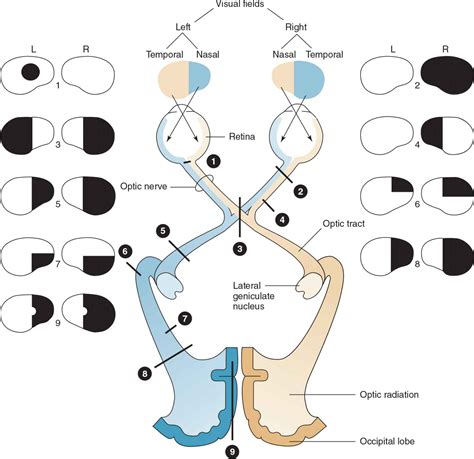 Image result for Types of Visual Field Defects