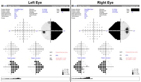 Afbeeldingsresultaten voor Peripheral Visual Field Defect