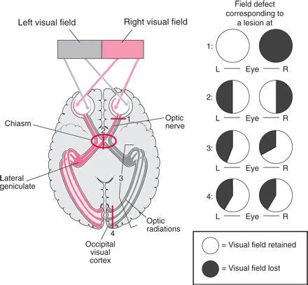 Image result for Visual Field Defects