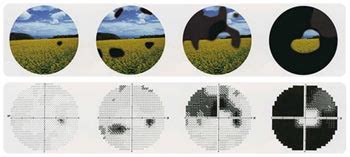 Image result for Advanced Glaucoma Visual Field