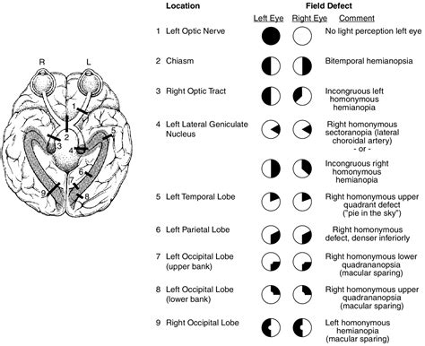 Image result for Visual Field Defect Names