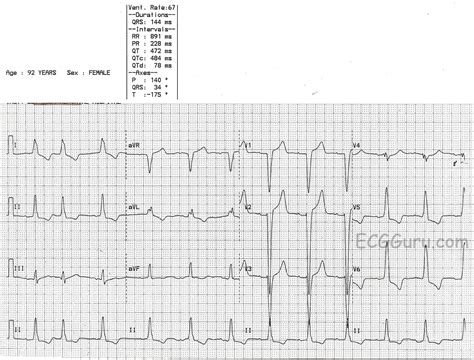 Image result for LBB ECG