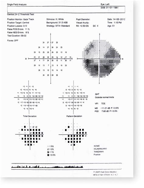 Image result for Advanced Glaucoma Visual Field