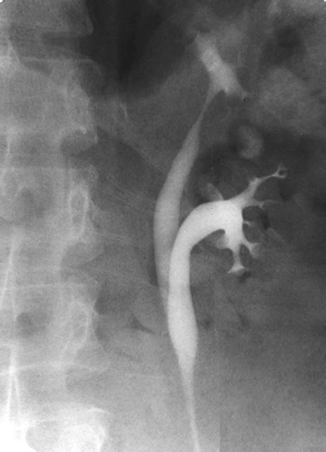 Image result for Duplication Disease