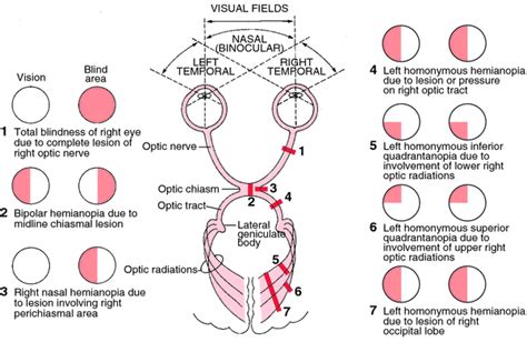 Monocular Visual Field Defect に対する画像結果