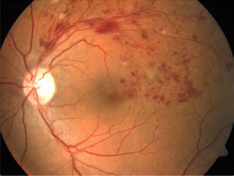 Image result for Superior Temporal Arcade Eye