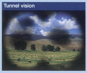 Tunnel Vision Visual Field Glaucoma に対する画像結果