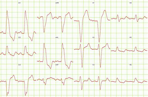 Image result for LBB ECG