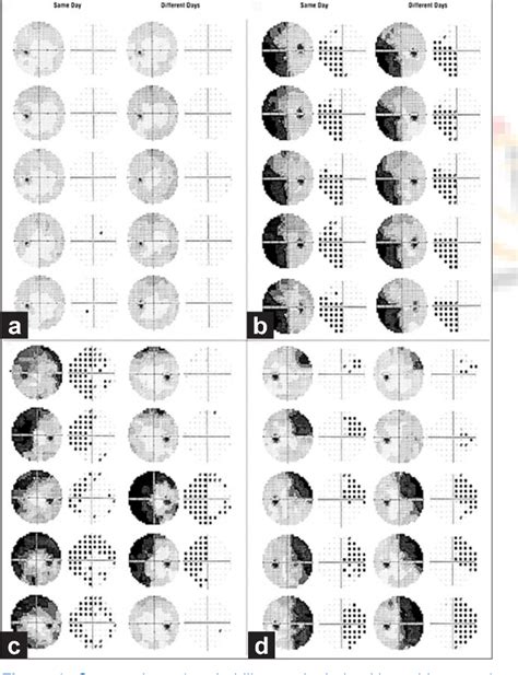 Toradh íomhá ar Neurologic Visual Field Defects