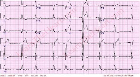Image result for LBB ECG