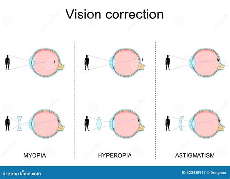 Toradh íomhá ar Normal Vision Hyperopia Myopia