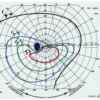 Image result for Deficit in One Visual Field
