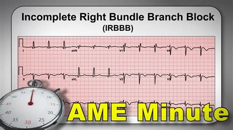 Toradh íomhá ar Left Bundle Branch Block and AFib