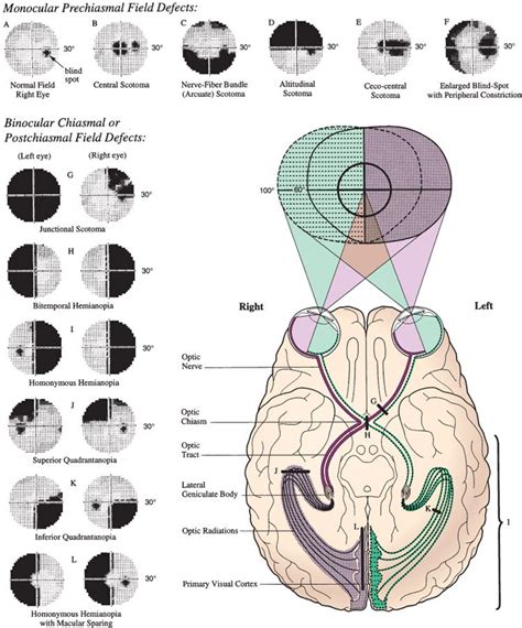 Image result for Temporal Visual Field Defect