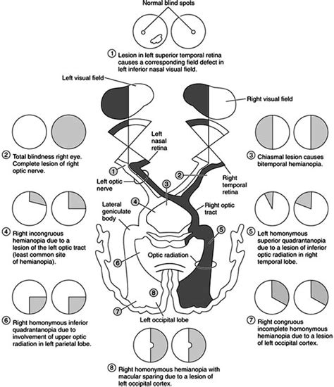 Image result for Types of Visual Field Defects