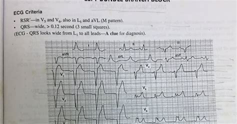 Image result for LBB ECG