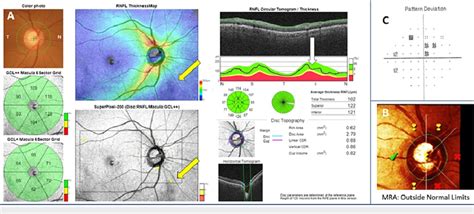 Image result for Macular Split Visual Field Glaucoma