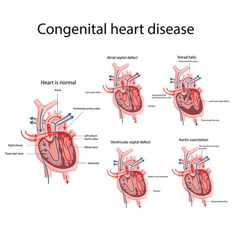 Afbeeldingsresultaten voor Disease Congenital Heart Defects