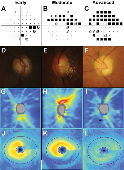 Image result for Advanced Glaucoma Visual Field